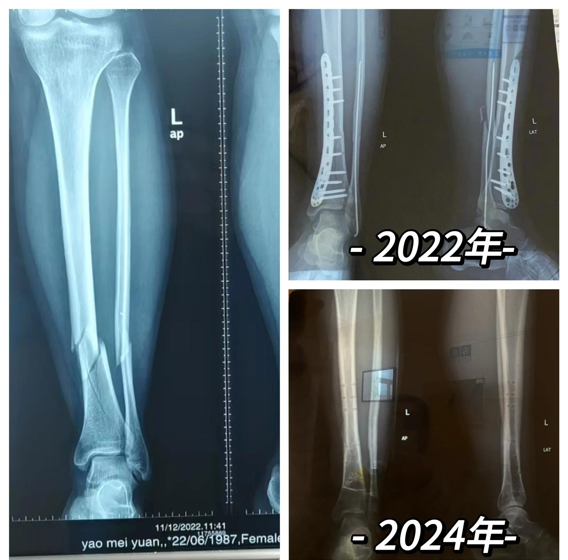 关于拜仁新星穆西亚拉腓骨骨折，将缺阵至少四个月！的信息